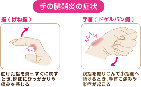 手の腱鞘炎の症状｜ばね指：曲げた指をまっすぐに戻す時、関節にひっかかりや痛みを感じる。ドゲルバン病：親指を握り込んで小指側へ傾けるとき、手首に痛みや炎症が起こる。